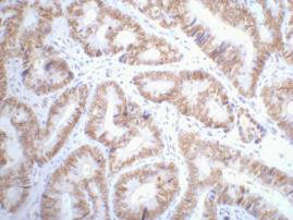 IHC staining of Human colon cancer tissue paraffin-embedded, diluted at 1:200.Mouse anti-H TP53 Monoclonal Antibody