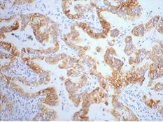 IHC staining of human lung cancer tissue, diluted at 1:200.