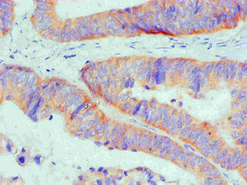 Immunohistochemical of paraffin-embedded Human Colon cancer tissue using BCL2L1 Monoclonal Antibody at dilution of 1:200mouse anti-Human BCL2L1 monoclonal antibody