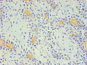 Immunohistochemical of paraffin-embedded Human breast cancer using the antibody (2E11-2B5) at dilution of 1:200.mouse anti-Human CD59 monoclonal antibody
