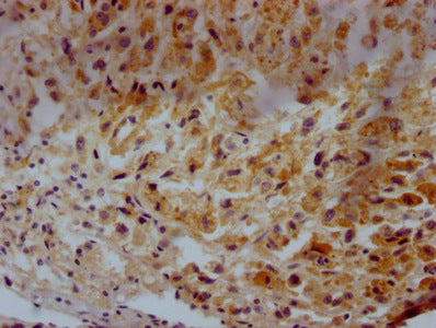 IHC image of CD63 Monoclonal Antibody diluted at 1:500 and staining in paraffin-embedded  human glioma tissue performed on a Leica BondTM system. After dewaxing and hydration, antigen retrieval was mediated by high pressure in a citrate buffer (pH 6.0). Section was blocked with 10% normal goat serum 30min at 37°C. Then primary antibody (1% BSA) was incubated at 4°C overnight. The primary is detected by a Goat anti-rabbit IgG labeled by HRP and visualized using 0.05% DAB.Mouse anti-Human CD63 Monoclonal Antibody antibody