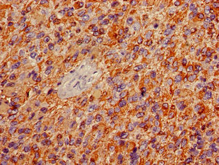 Immunohistochemistry of paraffin-embedded human glioma using GFAP Monoclonal Antibody at dilution of 1:100Mouse anti-Human GFAP Monoclonal Antibody