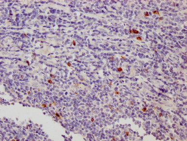 IHC image of LAG3 Monoclonal Antibody diluted at 1:500 and staining in paraffin-embedded human tonsil tissue performed on a Leica BondTM system. After dewaxing and hydration, antigen retrieval was mediated by high pressure in a citrate buffer (pH 6.0). Section was blocked with 10% normal goat serum 30min at 37°C Then primary antibody (1% BSA) was incubated at 4°C overnight. The primary is detected by a Goat anti-Mouse IgG labeled by HRP and visualized using 0.05% DAB.