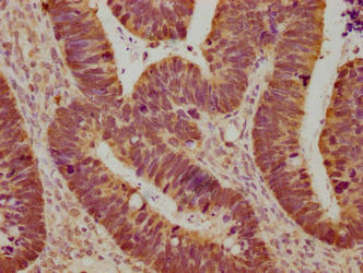 Immunohistochemical of paraffin-embedded human ovarian cancer using the antibody at dilution of 1:100