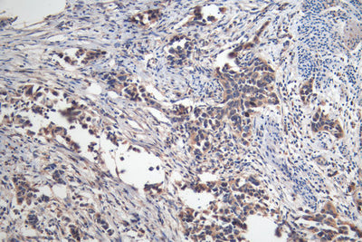 IHC image of MAGEA4 Monoclonal Antibody diluted at 1:200 and staining in paraffin-embedded human bladder cancer performed on a Leica BondTM system. After dewaxing and hydration, antigen retrieval was mediated by high pressure in a citrate buffer (pH 6.0). Section was blocked with 10% normal goat serum 30min at RT. Then primary antibody (1% BSA) was incubated at 4°C overnight. The primary is detected by a Goat anti-mouse polymer IgG labeled by HRP and visualized using 0.05% DAB.