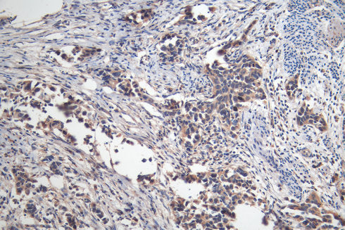 IHC image of MAGEA4 Monoclonal Antibody diluted at 1:200 and staining in paraffin-embedded human bladder cancer performed on a Leica BondTM system. After dewaxing and hydration, antigen retrieval was mediated by high pressure in a citrate buffer (pH 6.0). Section was blocked with 10% normal goat serum 30min at RT. Then primary antibody (1% BSA) was incubated at 4°C overnight. The primary is detected by a Goat anti-mouse polymer IgG labeled by HRP and visualized using 0.05% DAB.