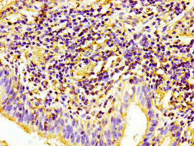 IHC image of CD31 Monoclonal Antibody diluted at 1:100 and staining in paraffin-embedded human lung cancer performed on a Leica BondTM system. After dewaxing and hydration, antigen retrieval was mediated by high pressure in a citrate buffer (pH 6.0). Section was blocked with 10% normal goat serum 30min at RT. Then primary antibody (1% BSA) was incubated at 4°C overnight. The primary is detected by a biotinylated secondary antibody and visualized using an HRP conjugated SP system.Mouse anti-Human CD31 Monoclonal Antibody