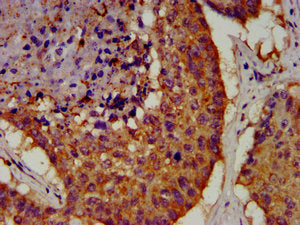 IHC image of OCT4 Monoclonal Antibody diluted at 1:100 and staining in paraffin-embedded human lung cancer performed on a Leica BondTM system. After dewaxing and hydration, antigen retrieval was mediated by high pressure in a citrate buffer (pH 6.0). Section was blocked with 10% normal goat serum 30min at RT. Then primary antibody (1% BSA) was incubated at 4°C overnight. The primary is detected by a biotinylated secondary antibody and visualized using an HRP conjugated SP system.Mouse anti-Human OCT4 Monoclonal Antibody
