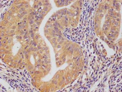 IHC image of PRDX3 Monoclonal Antibody diluted at 1:50 and staining in paraffin-embedded human endometrial cance tissue performed on a Leica BondTM system. After dewaxing and hydration, antigen retrieval was mediated by high pressure in a citrate buffer (pH 6.0). Section was blocked with 10% normal goat serum 30min at RT. Then primary antibody (1% BSA) was incubated at 4°C overnight. The primary is detected by a biotinylated secondary antibody and visualized using an HRP conjugated SP system.Mouse anti-Human PRDX3 Monoclonal antibody