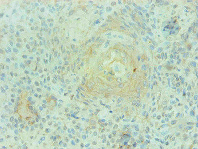 Immunohistochemical of paraffin-embedded human breast cancer using S100A9 Monoclonal Antibody at dilution of 1:200mouse anti-Human S100A9 monoclonal antibody