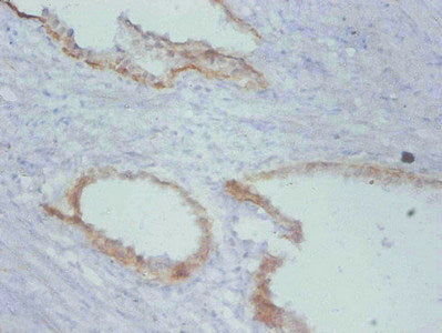Immunohistochemistry of paraffin-embedded human prostate cancer using TIMP1 Monoclonal Antibody at dilution of 1:100mouse anti-Human TIMP1 Monoclonal Antibody