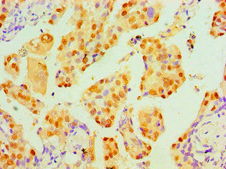 Immunohistochemical of paraffin-embedded Human lung cancer tissue using the antibody at dilution of 1:200.mouse anti-Human TP53 monoclonal antibody