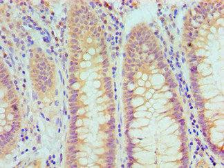 Immunohistochemical of paraffin-embedded Human  rectum cancer tissue using TP53 Monoclonal Antibody at dilution of 1:200.mouse anti-Human TP53 monoclonal antibody