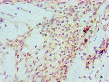 Immunohistochemical of paraffin-embedded Human breast cancer tissue using TP53 Monoclonal Antibody at dilution of 1:200.mouse anti-Human TP53 monoclonal antibody