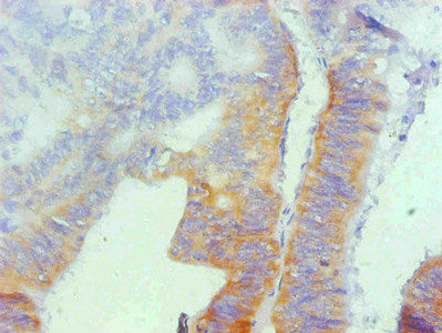 Immunohistochemical of paraffin-embedded human colon cancer using the antibody at dilution of 1:200mouse anti-Human SPP1 Monoclonal Antibody