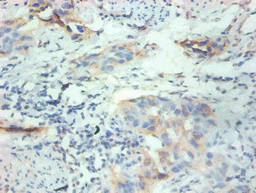 Immunohistochemical of paraffin-embedded human breast cancer tissue using the antibody at dilution of 1:200mouse anti-Human FABP3 Monoclonal Antibody