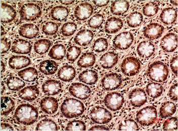 Immunohistochemical analysis of paraffin-embedded Human Colon Carcinoma Tissue using  TUBG1 Monoclonal Antibody diluted at 1:200.Mouse TUBG1 Monoclonal Antibody