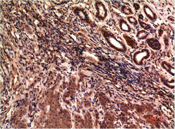 Immunohistochemical analysis of paraffin-embedded Human Breast Carcinoma Tissue using  TUBG1 Monoclonal Antibody diluted at 1:200.Mouse TUBG1 Monoclonal Antibody