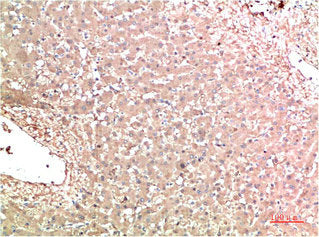 Immunohistochemical analysis of paraffin-embedded Human Liver Carcinoma Tissue using TTR Mouse mAb diluted at 1:200Mouse anti-Human TTR Monoclonal Antibody