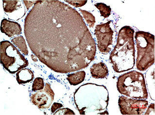 Immunohistochemical analysis of paraffin-embedded Human Thyroid Tissue using TTR Mouse mAb diluted at 1:200Mouse anti-Human TTR Monoclonal Antibody