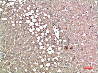 Immunohistochemical analysis of paraffin-embedded Human Liver Carcinoma Tissue using TTR Mouse mAb diluted at 1:200Mouse anti-Human TTR Monoclonal Antibody
