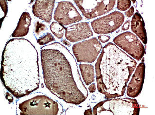 Immunohistochemical analysis of paraffin-embedded Human Thyroid Tissue using TTR Mouse mAb diluted at 1:200Mouse anti-Human TTR Monoclonal Antibody