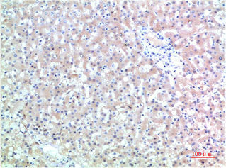Immunohistochemical analysis of paraffin-embedded Human Liver Carcinoma Tissue using TTR Mouse mAb diluted at 1:200Mouse anti-Human TTR Monoclonal Antibody