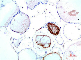 Immunohistochemical analysis of paraffin-embedded Human Thyroid Tissue using TTR Mouse mAb diluted at 1:200Mouse anti-Human TTR Monoclonal Antibody