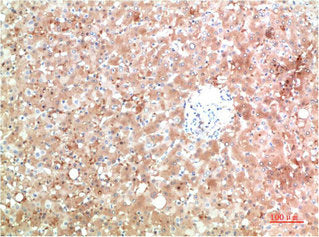 Immunohistochemical analysis of paraffin-embedded Human Liver Carcinoma Tissue using TTR Mouse mAb diluted at 1:200Mouse anti-Human TTR Monoclonal Antibody