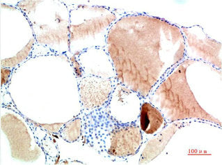 Immunohistochemical analysis of paraffin-embedded Human Thyroid Tissue using TTR Mouse mAb diluted at 1:200Mouse anti-Human TTR Monoclonal Antibody