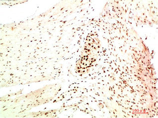Immunohistochemical analysis of paraffin-embedded Human Colon Carcinoma Tissue using HP-1 α Mouse mAb diluted at 1:200Mouse anti-Human CBX5 Monoclonal Antibody