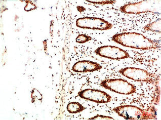 Immunohistochemical analysis of paraffin-embedded Human Colon Carcinoma Tissue using HP-1 α Mouse mAb diluted at 1:200Mouse anti-Human CBX5 Monoclonal Antibody