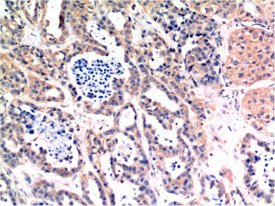 Immunohistochemical analysis of paraffin-embedded Human Breast Carcinoma Tissue using Bax Mouse mAb diluted at 1:200.Mouse anti-Human BAX Monoclonal Antibody