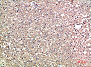 Immunohistochemical analysis of paraffin-embedded Human Liver Carcinoma Tissue using TTR Mouse mAb diluted at 1:200Mouse anti-Human TTR Monoclonal Antibody