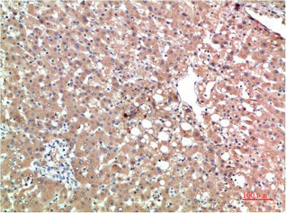 Immunohistochemical analysis of paraffin-embedded Human Liver Carcinoma Tissue using TTR Mouse mAb diluted at 1:200Mouse anti-Human TTR Monoclonal Antibody