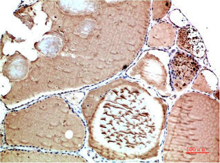 Immunohistochemical analysis of paraffin-embedded Human Thyroid Tissue using TTR Mouse mAb diluted at 1:200Mouse anti-Human TTR Monoclonal Antibody
