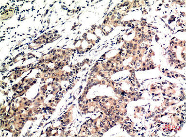 Immunohistochemical analysis of paraffin-embedded Human Breast Carcinoma Tissue using Ubiquitin Mouse mAb diluted at 1:200.Mouse anti-Human Ubiquitin Monoclonal Antibody