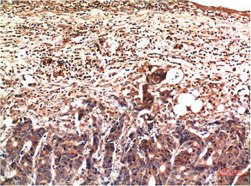 Immunohistochemical analysis of paraffin-embedded Human Stomach Carcinoma Tissue using Ubiquitin Mouse mAb diluted at 1:200.Mouse anti-Human Ubiquitin Monoclonal Antibody