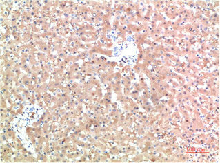 Immunohistochemical analysis of paraffin-embedded Human Liver Carcinoma Tissue using TTR Mouse mAb diluted at 1:200Mouse anti-Human TTR Monoclonal Antibody