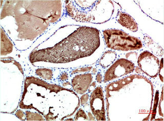 Immunohistochemical analysis of paraffin-embedded Human Liver Carcinoma Tissue using TTR Mouse mAb diluted at 1:200Mouse anti-Human TTR Monoclonal Antibody
