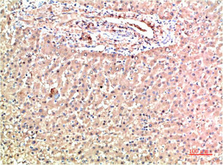 Immunohistochemical analysis of paraffin-embedded Human Liver Carcinoma Tissue using TTR Mouse mAb diluted at 1:200Mouse anti-Human TTR Monoclonal Antibody