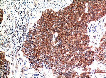Immunohistochemical analysis of paraffin-embedded Human Breast Carcinoma Tissue using Beclin-1 Mouse mAb diluted at 1:200.Mouse anti-Human BECN1 Monoclonal Antibody