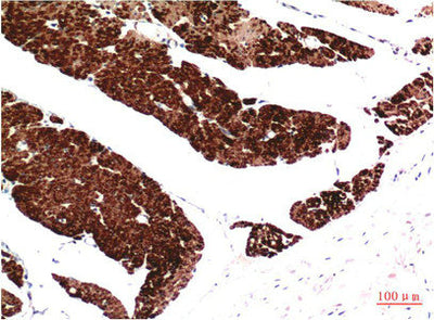 Immunohistochemical analysis of paraffin-embedded Human Colon Carcinoma Tissue using Muscle Actin Mouse mAb diluted at 1:200.Mouse anti-Human Muscle actin Monoclonal Antibody