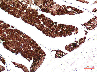 Immunohistochemical analysis of paraffin-embedded Human Colon Carcinoma Tissue using Muscle Actin Mouse mAb diluted at 1:200.Mouse anti-Human Muscle actin Monoclonal Antibody