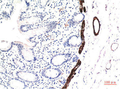 Immunohistochemical analysis of paraffin-embedded Human Colon Carcinoma Tissue using Muscle Actin Mouse mAb diluted at 1:200.Mouse anti-Human Muscle actin Monoclonal Antibody