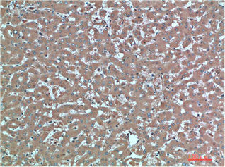Immunohistochemical analysis of paraffin-embedded Human Liver Carcinoma Tissue using TTR Mouse mAb diluted at 1:200Mouse anti-Human TTR Monoclonal Antibody