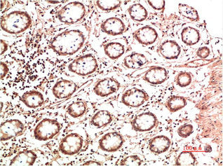 Immunohistochemical analysis of paraffin-embedded Human Colon Carcinoma Tissue using Collagen II Mouse mAb diluted at 1:500Mouse anti-Human COL2A1 Monoclonal Antibody