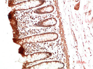 Immunohistochemical analysis of paraffin-embedded Human Colon Carcinoma Tissue using Collagen II Mouse mAb diluted at 1:500Mouse anti-Human COL2A1 Monoclonal Antibody