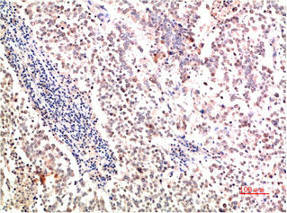 Immunohistochemical analysis of paraffin-embedded Human Lung Carcinoma Tissue using Collagen II Mouse mAb diluted at 1:500Mouse anti-Human COL2A1 Monoclonal Antibody