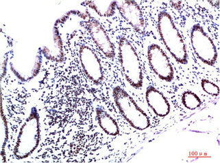 Immunohistochemical analysis of paraffin-embedded Human Colon Carcinoma Tissue using HP-1γ Mouse mAb diluted at 1:200Mouse anti-Human CBX3 Monoclonal Antibody